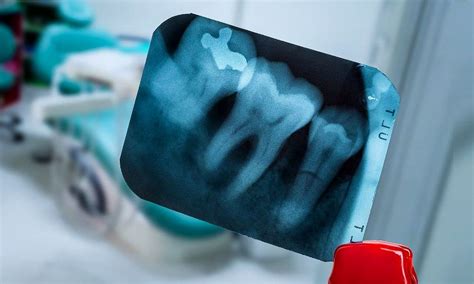 Dental radiology
